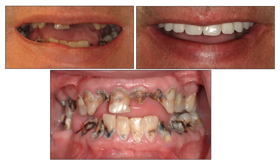 Before and after dental restoration case 1 by Dr. Jmi Asam at Pacific Dental & Implant Solutions, Honolulu