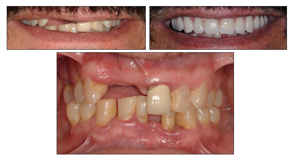Before and after dental restoration case 2 by Dr. Jmi Asam at Pacific Dental & Implant Solutions, Honolulu