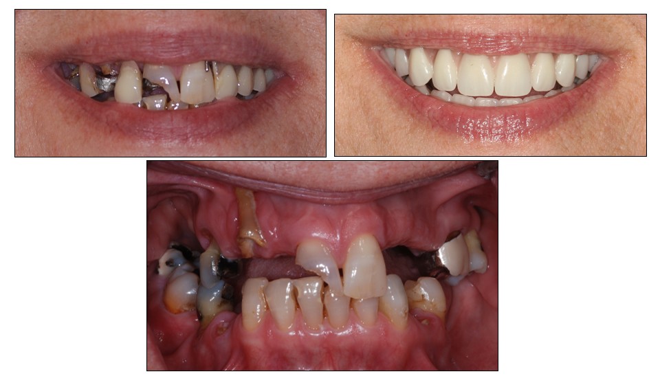 Before and after dental restoration case 3 by Dr. Jmi Asam at Pacific Dental & Implant Solutions, Honolulu