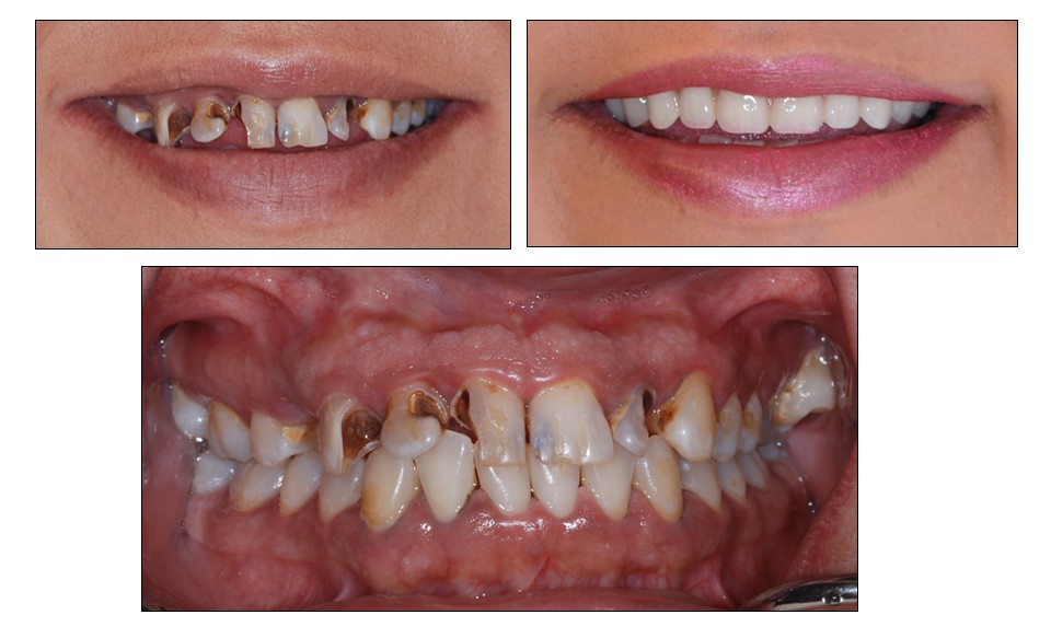 Before and after dental restoration case 4 by Dr. Jmi Asam at Pacific Dental & Implant Solutions, Honolulu