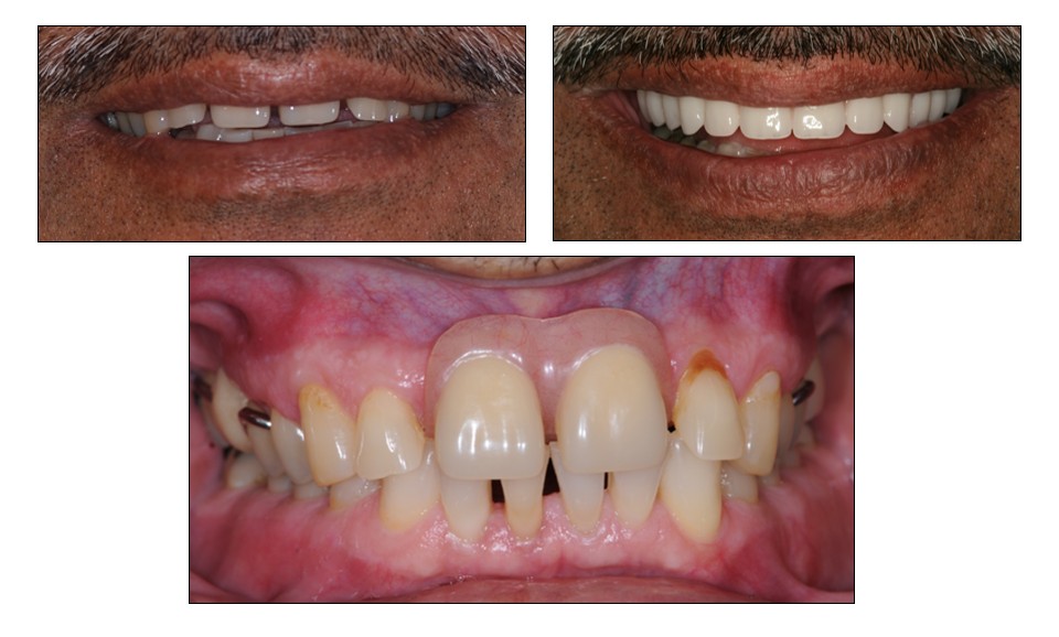 Before and after dental restoration case 5 by Dr. Jmi Asam at Pacific Dental & Implant Solutions, Honolulu