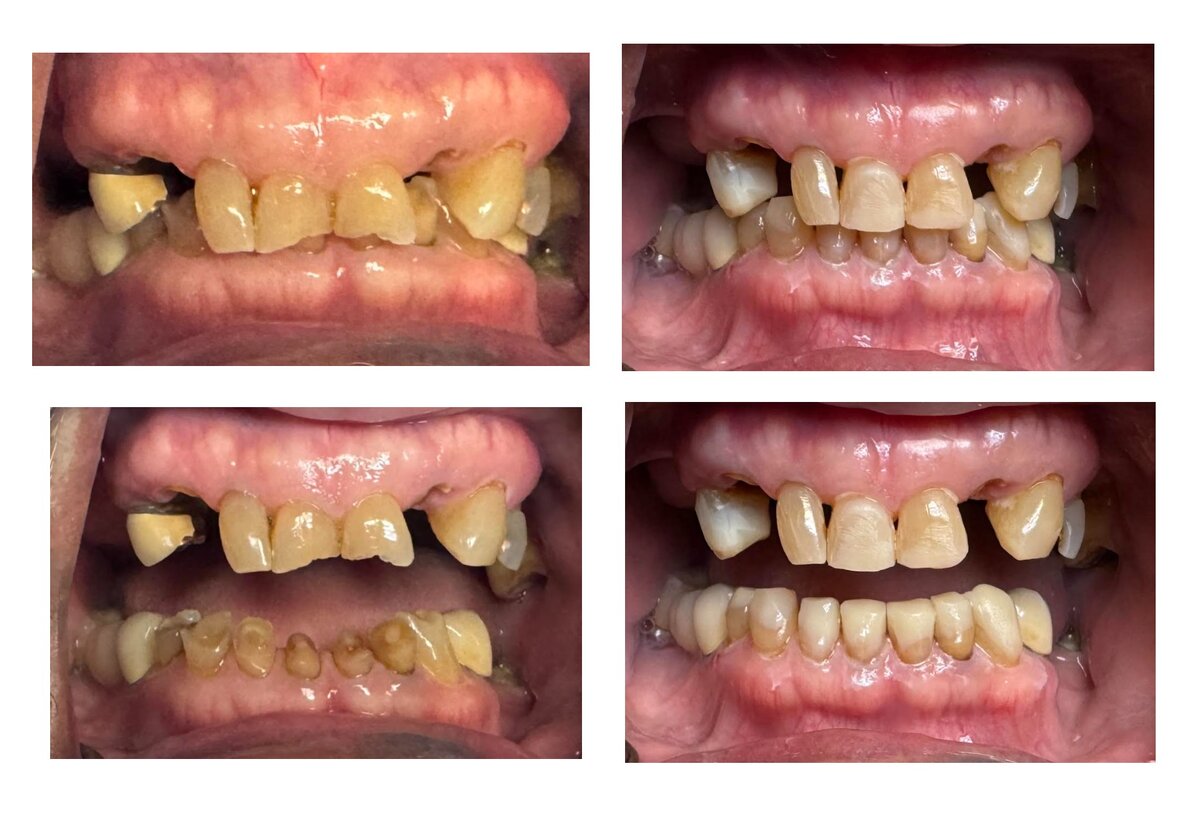Before and after dental restoration case 6 by Dr. Jmi Asam at Pacific Dental & Implant Solutions, Honolulu