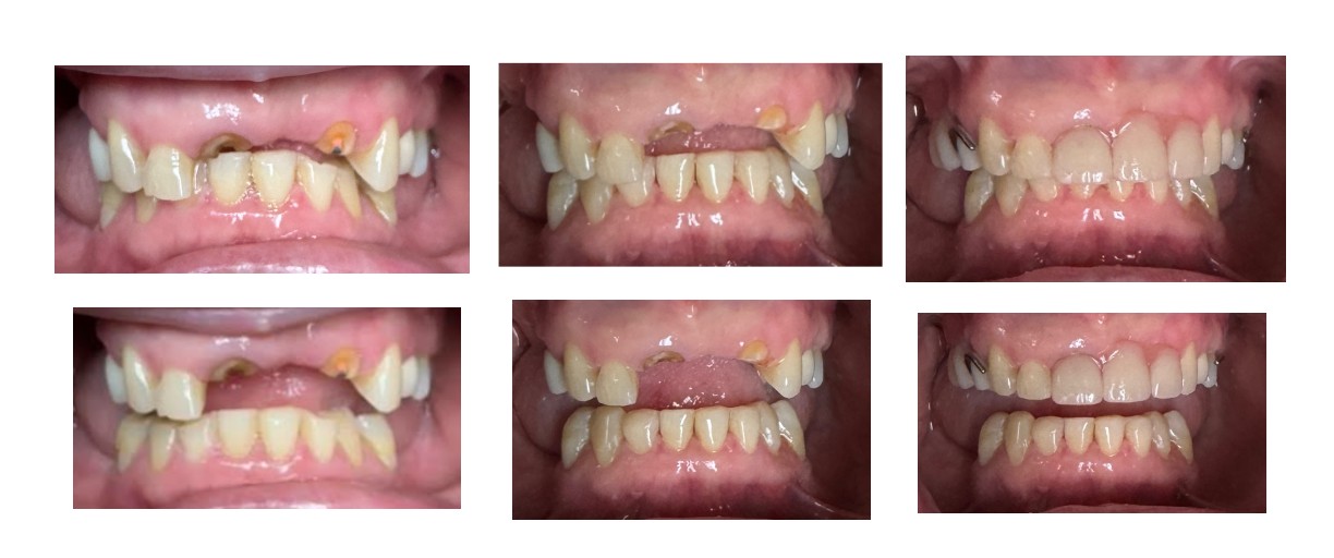 Before and after dental restoration case 7 by Dr. Jmi Asam at Pacific Dental & Implant Solutions, Honolulu