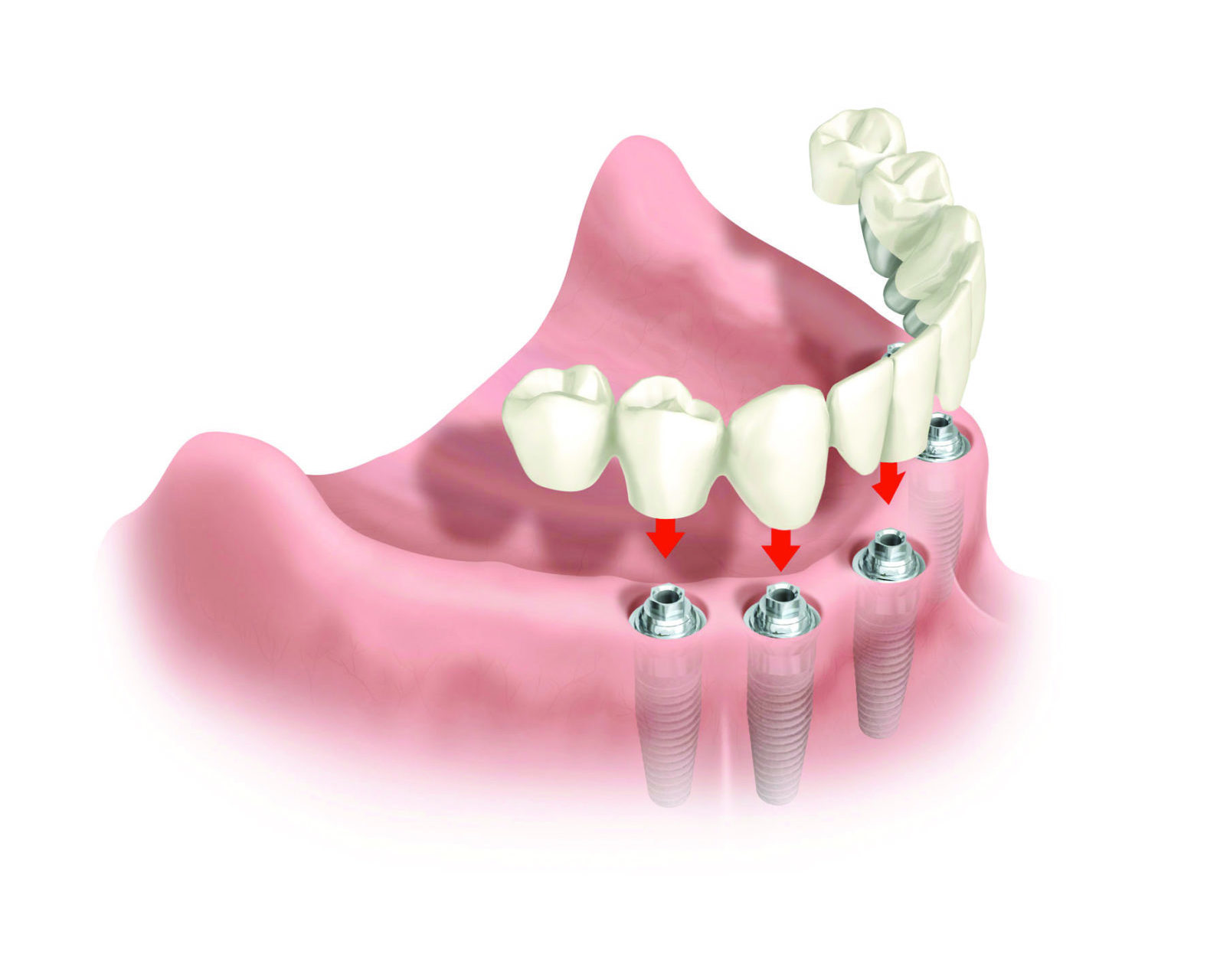 All on four dental implants