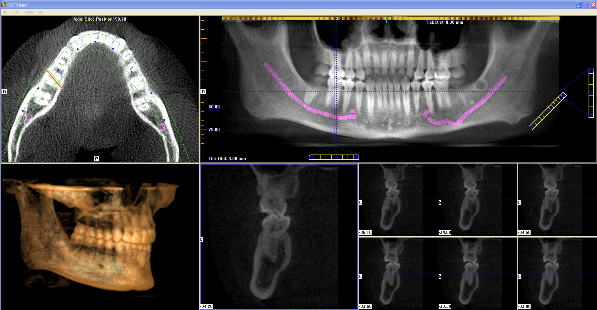 3d ct scan dental implants