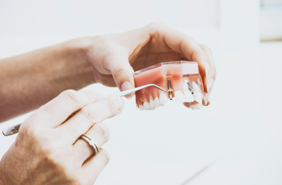 Dental Implants: a Guide for Patients