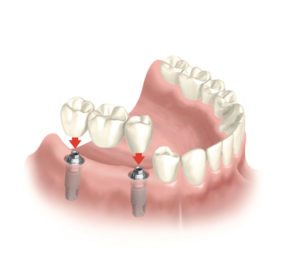 dental-tooth-bridge-honolulu